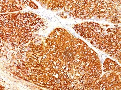 Melanoma Marker Monoclonal Mouse Antibody (HMB45 + A103 + T311)