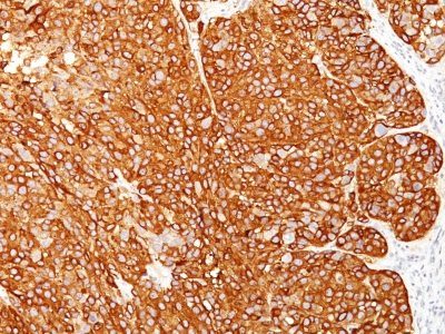 Melanoma Marker Monoclonal Mouse Antibody (HMB45 + M2-7C10 + M2-9E3 + T311)