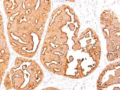 Mucin 1 / EMA / Episialin / CD227 Monoclonal Mouse Antibody (MUC1/967)